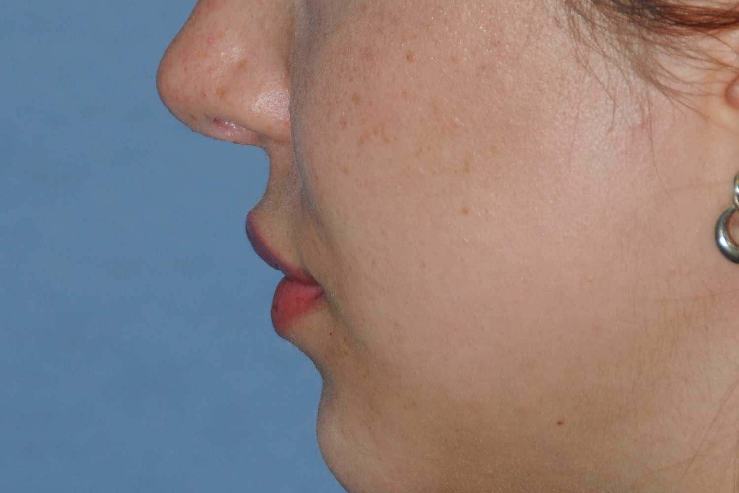 Lip Augmentation / Injection Before & After Photo