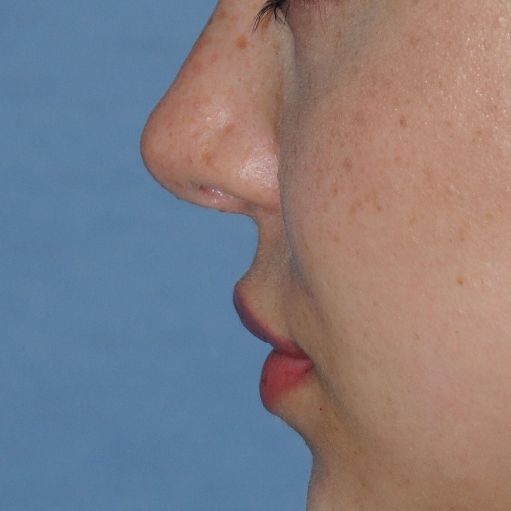 Lip Augmentation / Injection Before & After Photo