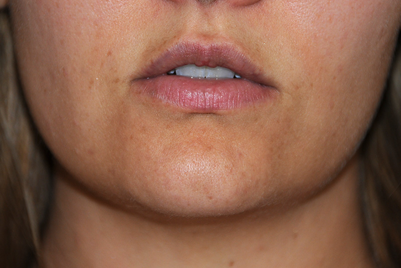 Lip Augmentation / Injection Before & After Photo