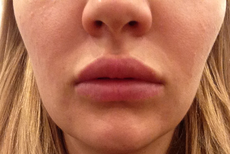 Lip Augmentation / Injection Before & After Photo