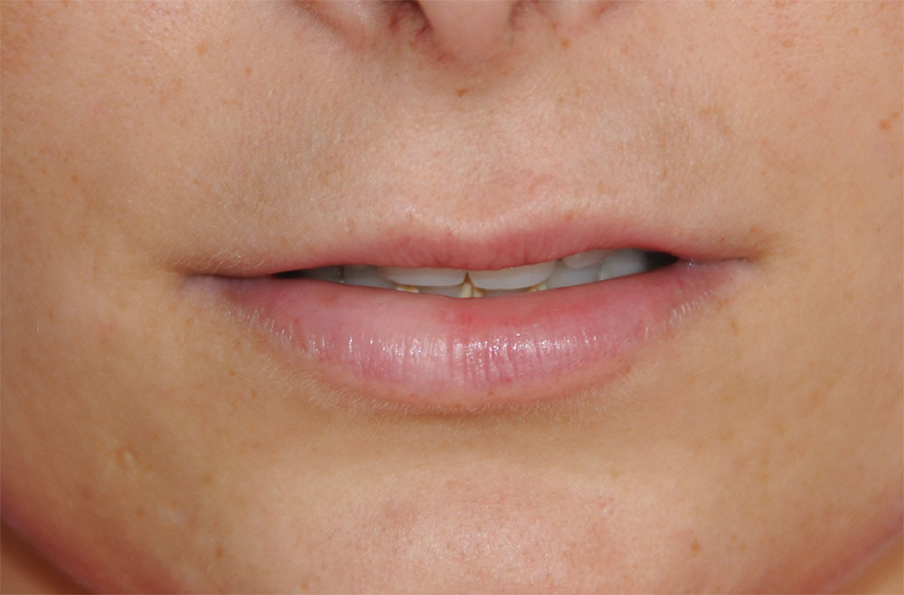 Lip Augmentation / Injection Before & After Photo