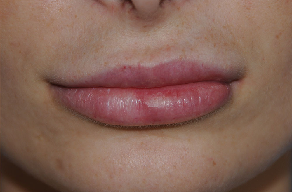 Lip Augmentation / Injection Before & After Photo