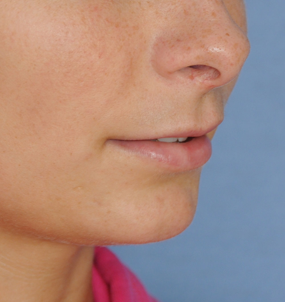 Lip Augmentation / Injection Before & After Photo