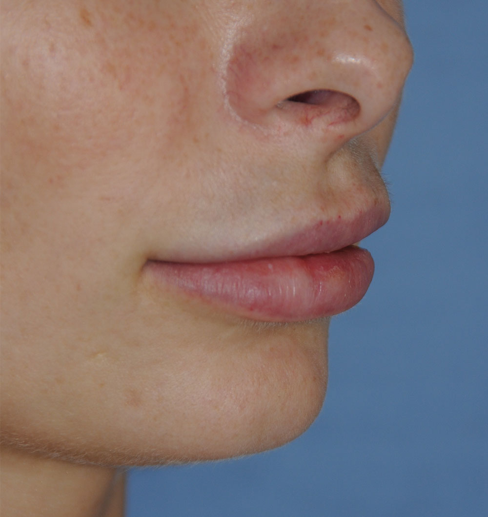 Lip Augmentation / Injection Before & After Photo