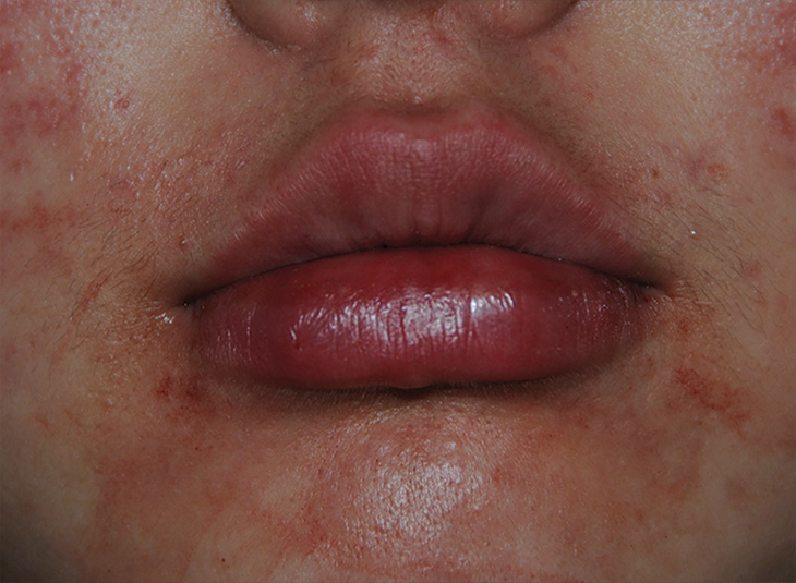 Lip Augmentation / Injection Before & After Photo