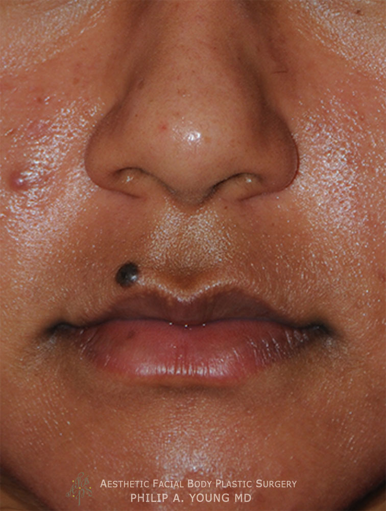 Lip Augmentation / Injection Before & After Photo