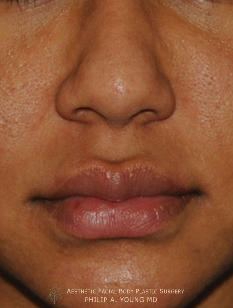 Lip Augmentation / Injection Before & After Photo