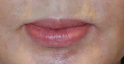 Lip Augmentation / Injection Before & After Photo