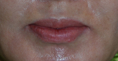 Lip Augmentation / Injection Before & After Photo