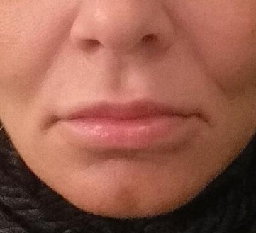 Lip Augmentation / Injection Before & After Photo