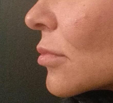 Lip Augmentation / Injection Before & After Photo