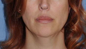 Lip Augmentation / Injection Before & After Photo