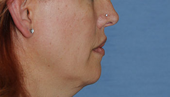 Lip Augmentation / Injection Before & After Photo