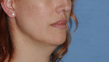 Lip Augmentation / Injection Before & After Photo