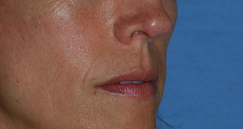 Lip Augmentation / Injection Before & After Photo