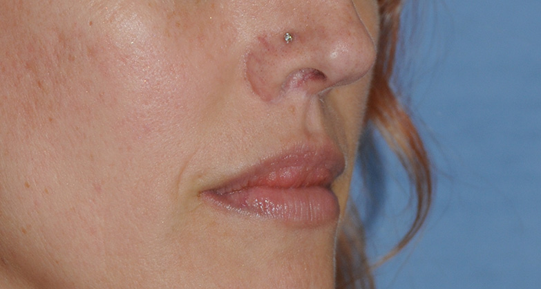 Lip Augmentation / Injection Before & After Photo