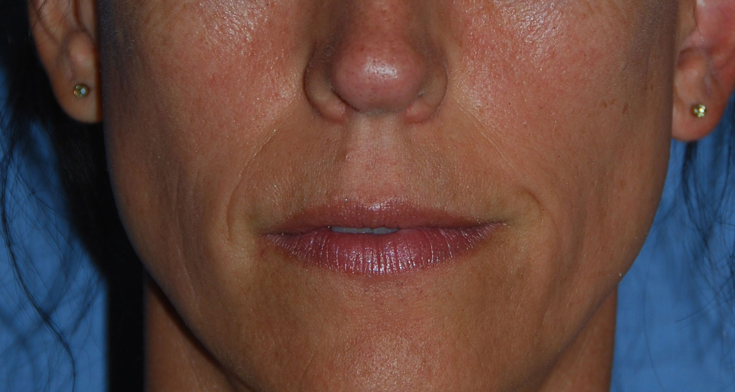 Lip Augmentation / Injection Before & After Photo