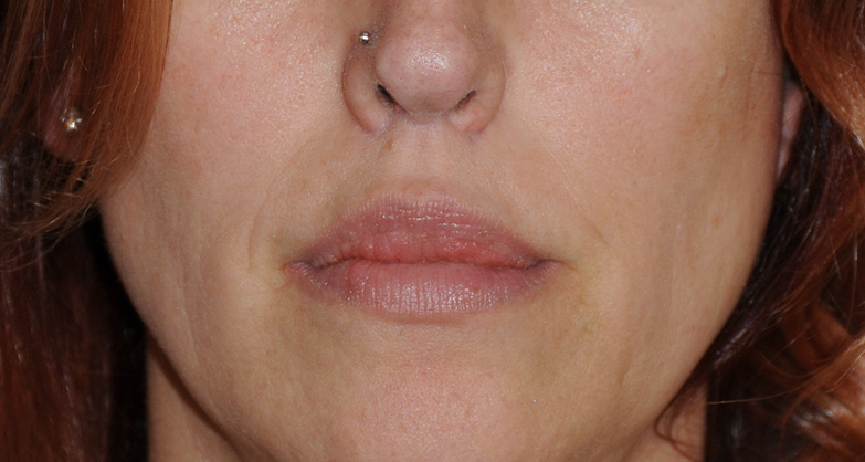 Lip Augmentation / Injection Before & After Photo