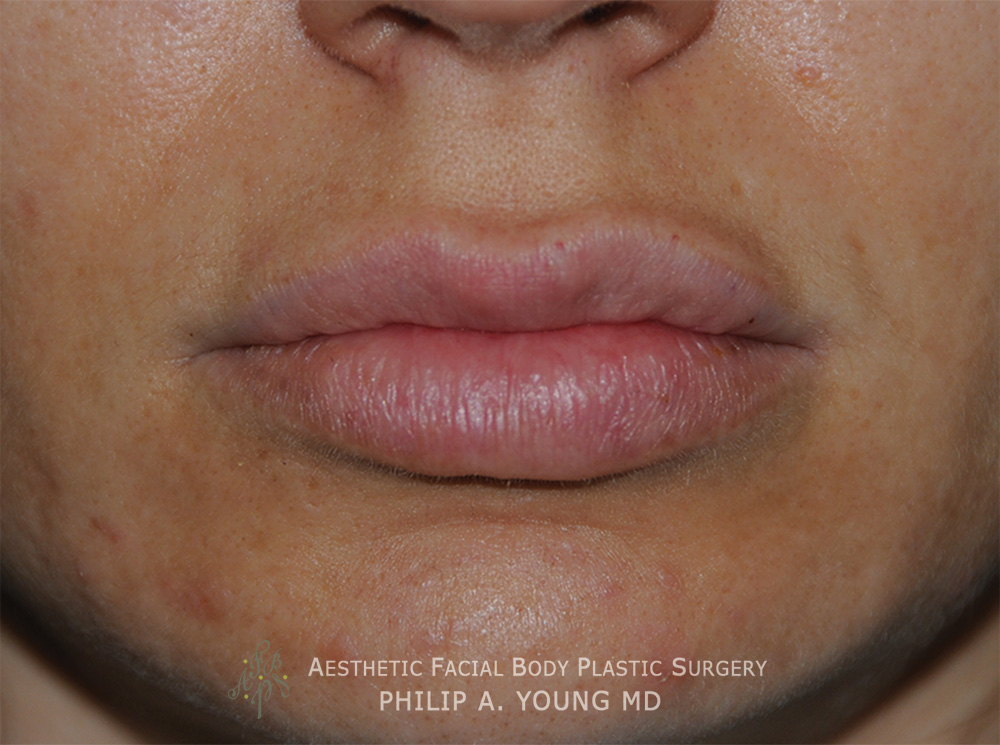 Lip Augmentation / Injection Before & After Photo