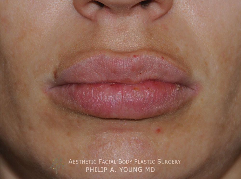 Lip Augmentation / Injection Before & After Photo