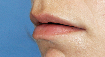 Lip Augmentation / Injection Before & After Photo