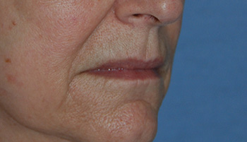 Lip Augmentation / Injection Before & After Photo