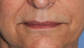 Lip Augmentation / Injection Before & After Photo