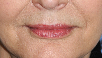 Lip Augmentation / Injection Before & After Photo