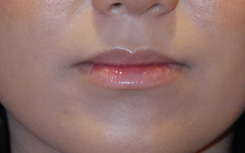 Lip Augmentation / Injection Before & After Photo