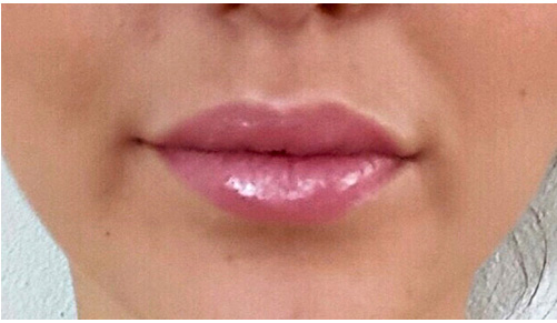 Lip Augmentation / Injection Before & After Photo