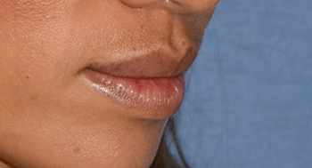 Lip Augmentation / Injection Before & After Photo