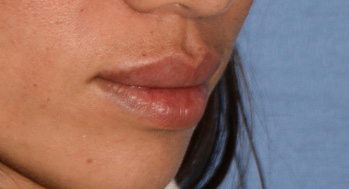 Lip Augmentation / Injection Before & After Photo