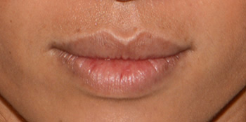 Lip Augmentation / Injection Before & After Photo