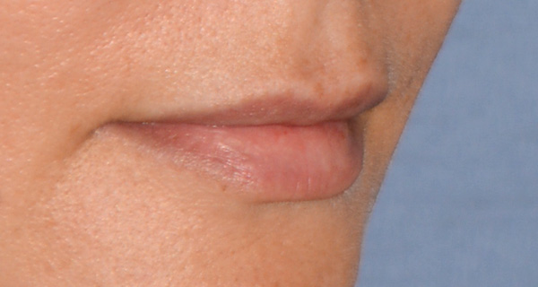 Lip Augmentation / Injection Before & After Photo