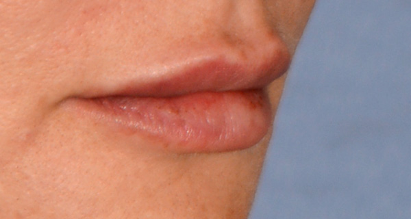 Lip Augmentation / Injection Before & After Photo