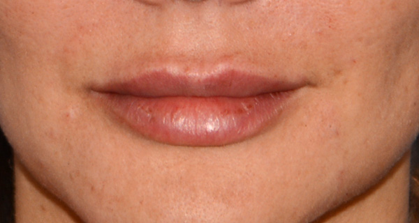 Lip Augmentation / Injection Before & After Photo