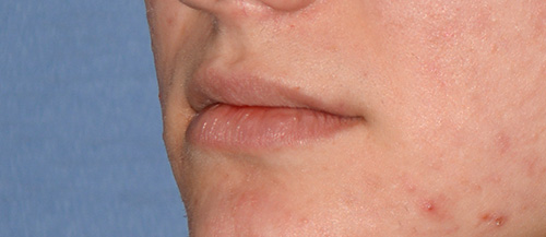 Lip Augmentation / Injection Before & After Photo