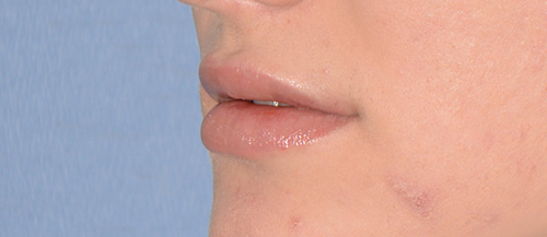 Lip Augmentation / Injection Before & After Photo