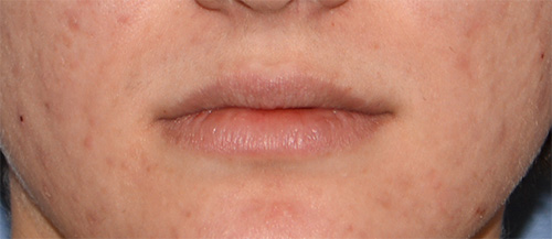 Lip Augmentation / Injection Before & After Photo