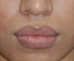 Lip Augmentation / Injection Before & After Photo