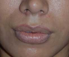 Lip Augmentation / Injection Before & After Photo