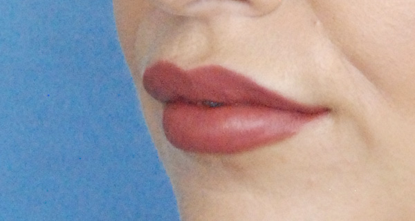 Lip Augmentation / Injection Before & After Photo