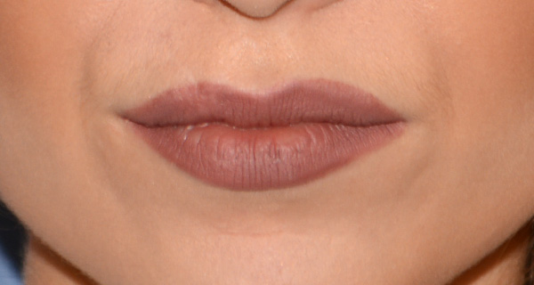 Lip Augmentation / Injection Before & After Photo