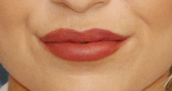 Lip Augmentation / Injection Before & After Photo