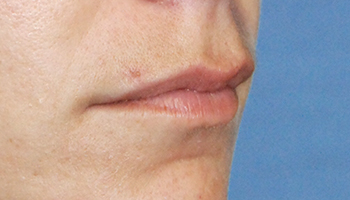 Lip Augmentation / Injection Before & After Photo