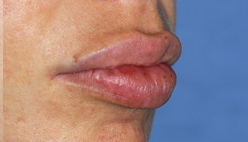 Lip Augmentation / Injection Before & After Photo