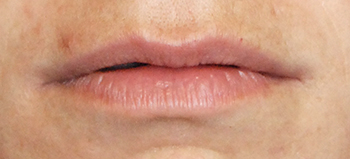 Lip Augmentation / Injection Before & After Photo