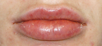 Lip Augmentation / Injection Before & After Photo