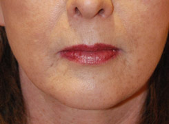 Lip Augmentation / Injection Before & After Photo