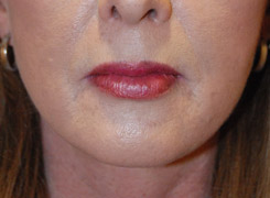 Lip Augmentation / Injection Before & After Photo